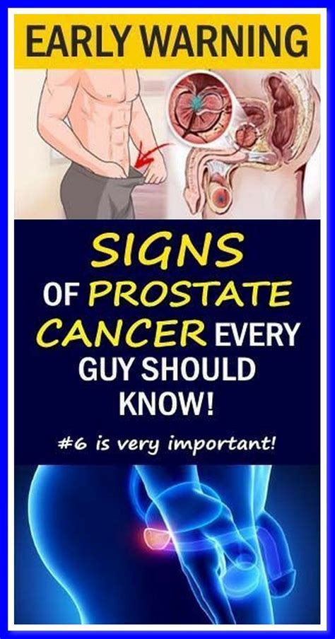 12 early warning signs of prostate cancer that every guy needs to know ...