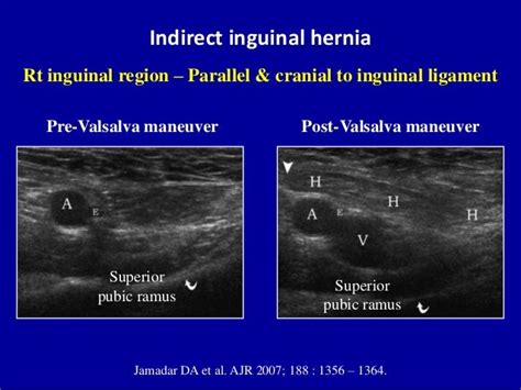 Ultrasound of the abdominal wall hernias