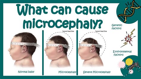 Microcephaly | What is the main cause of microcephaly? | What is life expectancy for ...