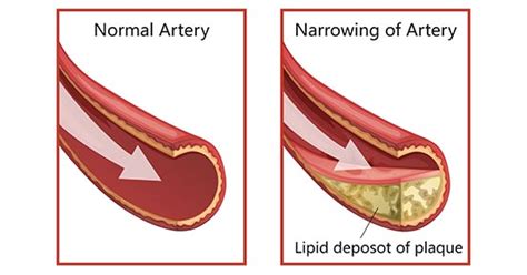 What is Coronary Artery Disease and How Does it Develop?- CUSABIO