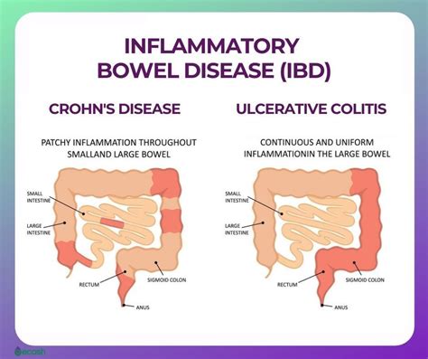 Tim Crowe on LinkedIn: Inflammatory bowel disease (IBD) is an umbrella ...