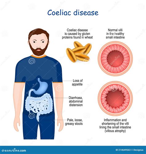 Coeliac Disease Or Celiac Disease. Small Bowel Showing Coeliac D ...