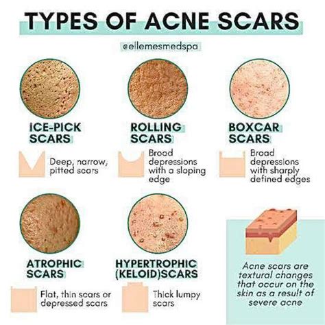 Types of acne scars