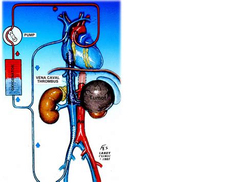 Comparative Effectiveness of Median Sternotomy vs Minimal Access Cardiopulmonary Bypass and ...