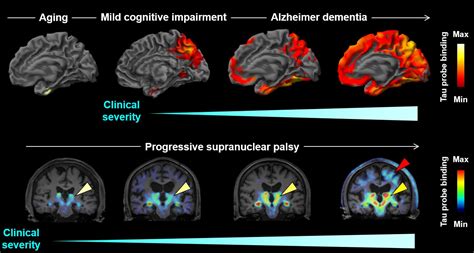 Brain imaging of tau protein in patients with various forms of dementia