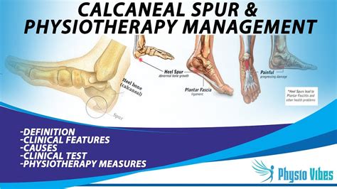 Calcaneal Spur Exercises