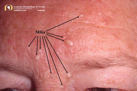 Milia: Milium, Milia En Plaque... - Academic Dermatology of Nevada