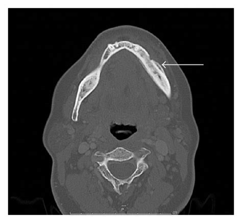 CT scan of the mandible. The CT scan demonstrates thickening of the ...