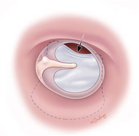 Anterior Perforation Repair – Oto Surgery Atlas