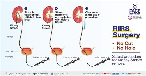 RIRS Surgery in Hyderabad – Indications, Side Effects and Benefits