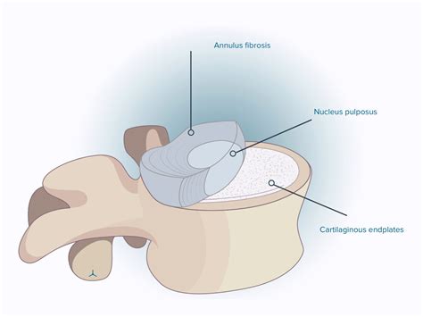 Herniated Disc L5/S1 Guide - treatment, causes and symptoms