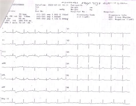 Dilated cardiomyopathy - Kauvery Hospital