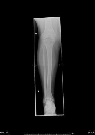 X-ray artifacts | Radiology Reference Article | Radiopaedia.org