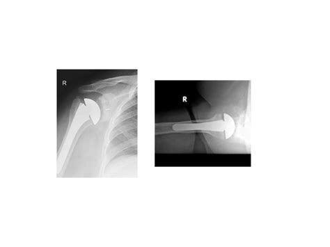 Glenohumeral Degenerative Disease: Osteoarthritis - Cancer Therapy Advisor