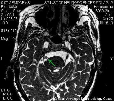 Neuroradiology Cases: Vascular loop syndrome