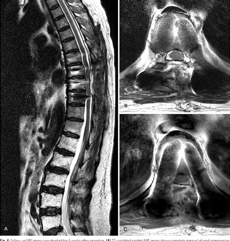 Figure 4 from Myelopathy due to Thoracic Intradural Extramedullary Tumor Misdiagnosed as the ...