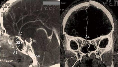 Occlusion of the anterior cerebral artery after head trauma