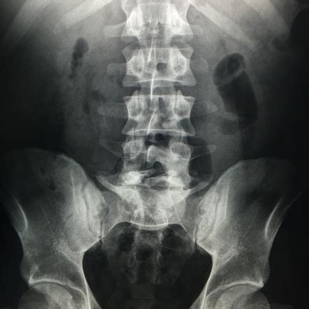 Spina bifida occulta | Radiology Reference Article | Radiopaedia.org