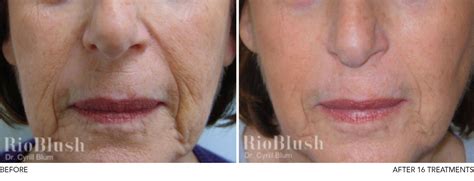 Rioblush Carboxytherapy - Cosmetic Clinic Burnley Lancashire