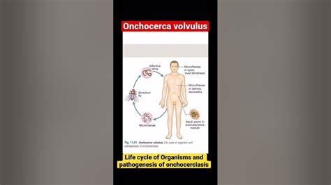 Onchocerca volvulus | Life cycle of organisms and pathogenesis of ...