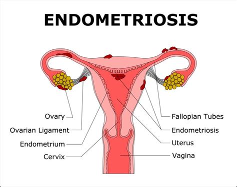 What is Endometriosis? - Sunshine State Women's Care, LLC