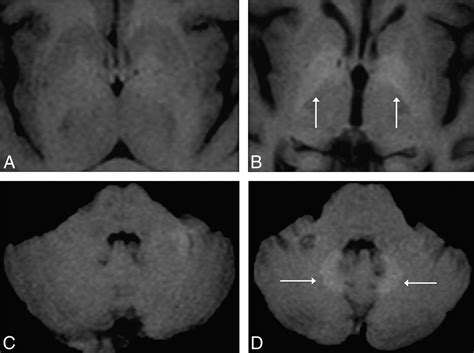 Gadolinium Mri Contrast