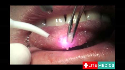 Laser Lingual Fibroma Removal by LITEMEDICS - YouTube