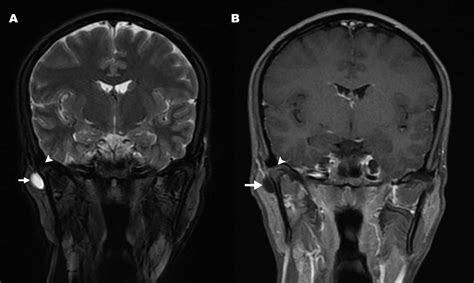 A Synovial Cyst of the Temporomandibular Joint | The Journal of Rheumatology