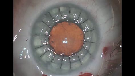 Cornea transplant on an eye with prior RK surgery in 3 minutes - Shannon Wong, MD. 6/5/16. - YouTube