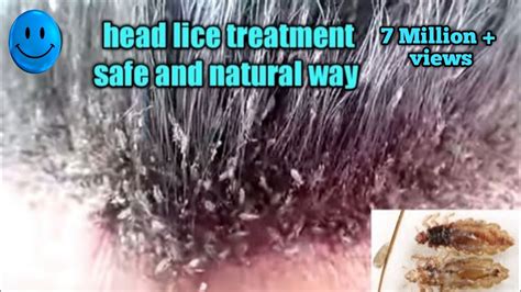 Head lice treatment the safe and natural way/how to remove lice from ...