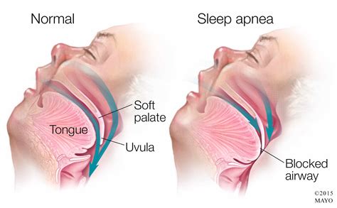 Sleep apnea: The serious sleep disorder - Mayo Clinic News Network