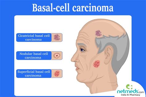 Basal Cell Carcinoma: Causes, Symptoms And Treatment | Netmeds