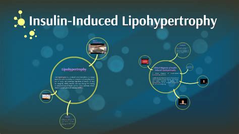 Insulin-Induced Lipohypertrophy by Cynthia De la Torre on Prezi