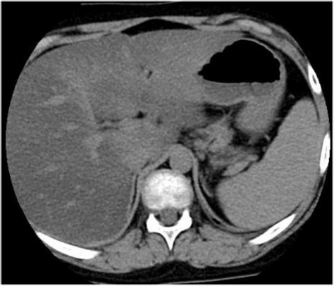 Computed tomography (CT) scan of the adrenal gland showed nodular ...