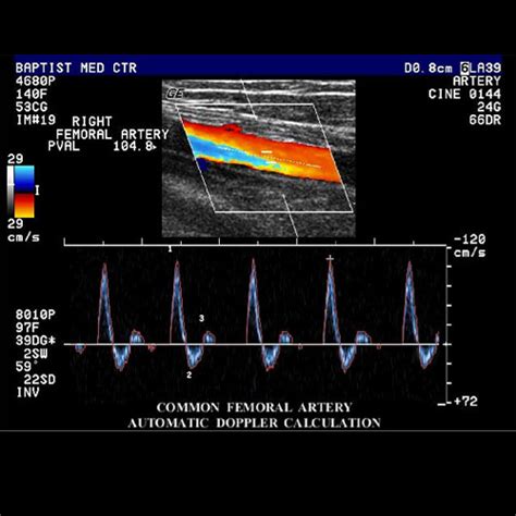 Excelente Horror admiración vascular duplex dedo privado Sillón