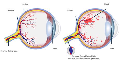 Retinal vein occlusion causes, symptoms, diagnosis, treatment & prognosis