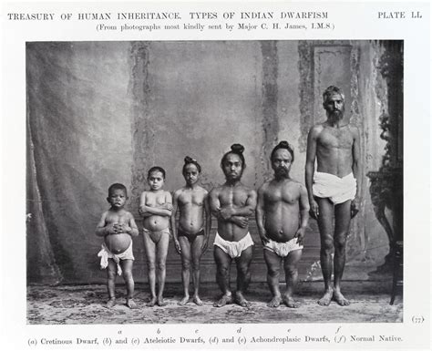 Types of "Indian Dwarfism". front view | Wellcome Collection