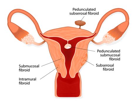 Fibroid_Types