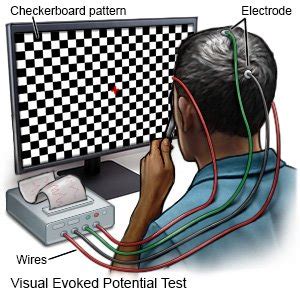 Evoked Potential Tests - What You Need to Know