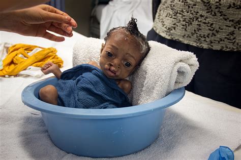 Children's Health - Cleft Lip Surgeries - Mercy Ships Australia