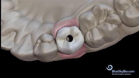 Screw Retained Crown Laboratory Bonding - YouTube