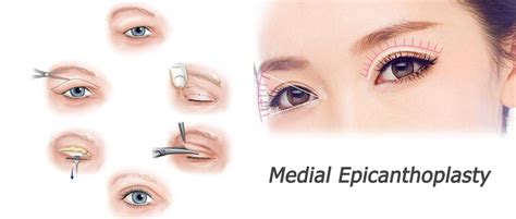 Medial Epicanthoplasty – Nobel Medical Group