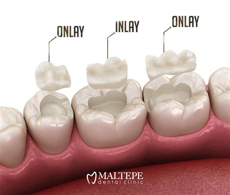 Composite Inlays and Onlays: A Durable and Affordable Option - Maltepe ...