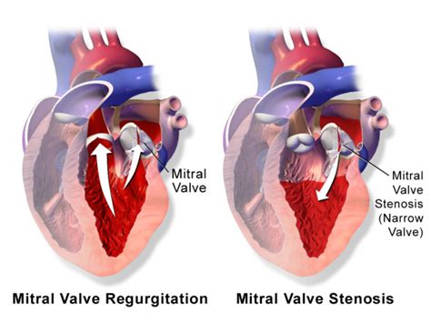 Mitral Valve Disease - Newport Cardiac & Thoracic Surgery