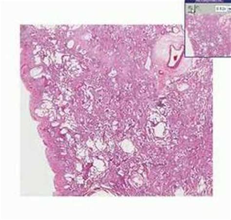 Histopathology Lung--Diffuse interstitial fibrosis - YouTube