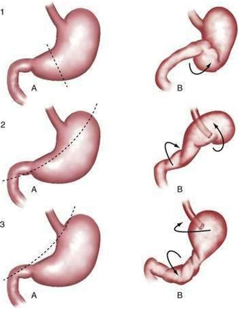 Abdominal Hernias and Gastric Volvulus | Clinical Gate