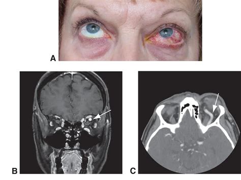 Carotid-cavernous fistula - American Academy of Ophthalmology