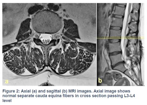 View of What happened to cauda equina fibers? Adhesive arachnoiditis ...