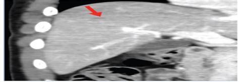 Solid Organ Injury Grading in the Abdomen: A Primer for Emer ...