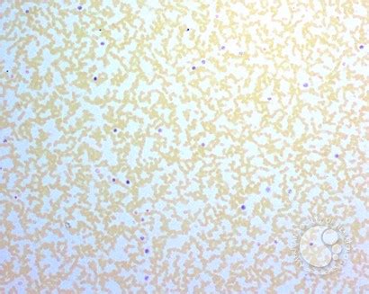 Leukocyte Alkaline Phosphatase Scoring - 2.